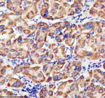 Immunohistochemical staining of TIMM9 using anti-TIMM9 antibody. TIMM9 was detected in a paraffin-embedded section of human liver cancer tissue. Heat mediated antigen retrieval was performed in EDTA buffer (pH 8.0, epitope retrieval solution). The tissue section was blocked with 10% goat serum. The tissue section was then incubated with 2 ug/ml rabbit anti-TIMM9 antibody overnight at 4oC. Peroxidase Conjugated Goat Anti-rabbit IgG was used as secondary antibody and incubated for 30 minutes at 37oC. The tissue section was developed using an HRP secondary and DAB substrate.