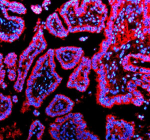 Immunofluorescent staining of TIMM9 using anti-TIMM9 antibody (red). TIMM9 was detected in a paraffin-embedded section of human lung cancer tissue. Heat mediated antigen retrieval was performed in EDTA buffer (pH 8.0, epitope retrieval solution). The tissue section was blocked with 10% goat serum. The tissue section was then incubated with 5 ug/ml rabbit anti-TIMM9 antibody overnight at 4oC. Cy3 Conjugated Goat Anti-Rabbit IgG was used as secondary antibody at 1:500 dilution and incubated for 30 minutes at 37oC. The section was counterstained with DAPI nuclear stain (blue). Visualize using a fluorescence microscope and filter sets appropriate for the label used.
