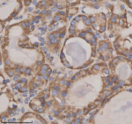 Immunohistochemical staining of GFRA2 using anti-GFRA2 antibody. GFRA2 was detected in a paraffin-embedded section of human thyroid cancer tissue. Heat mediated antigen retrieval was performed in EDTA buffer (pH 8.0, epitope retrieval solution). The tissue section was blocked with 10% goat serum. The tissue section was then incubated with 2 ug/ml rabbit anti-GFRA2 antibody overnight at 4oC. Peroxidase Conjugated Goat Anti-rabbit IgG was used as secondary antibody and incubated for 30 minutes at 37oC. The tissue section was developed using an HRP secondary and DAB substrate.