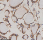 Immunohistochemical staining of GFRA2 using anti-GFRA2 antibody. GFRA2 was detected in a paraffin-embedded section of human thyroid cancer tissue. Heat mediated antigen retrieval was performed in EDTA buffer (pH 8.0, epitope retrieval solution). The tissue section was blocked with 10% goat serum. The tissue section was then incubated with 2 ug/ml rabbit anti-GFRA2 antibody overnight at 4oC. Peroxidase Conjugated Goat Anti-rabbit IgG was used as secondary antibody and incubated for 30 minutes at 37oC. The tissue section was developed using an HRP secondary and DAB substrate.