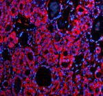 Immunofluorescent staining of GFRA2 using anti-GFRA2 antibody (red). GFRA2 was detected in a paraffin-embedded section of human thyroid cancer tissue. Heat mediated antigen retrieval was performed in EDTA buffer (pH 8.0, epitope retrieval solution). The tissue section was blocked with 10% goat serum. The tissue section was then incubated with 5 ug/ml rabbit anti-GFRA2 antibody overnight at 4oC. Cy3 Conjugated Goat Anti-Rabbit IgG was used as secondary antibody at 1:500 dilution and incubated for 30 minutes at 37oC. The section was counterstained with DAPI nuclear stain (blue). Visualize using a fluorescence microscope and filter sets appropriate for the label used.