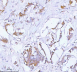 Immunohistochemical staining of PCYOX1 using anti-PCYOX1 antibody. PCYOX1 was detected in a paraffin-embedded section of human breast cancer tissue. Heat mediated antigen retrieval was performed in EDTA buffer (pH 8.0, epitope retrieval solution). The tissue section was blocked with 10% goat serum. The tissue section was then incubated with 2 ug/ml rabbit anti-PCYOX1 antibody overnight at 4oC. Peroxidase Conjugated Goat Anti-rabbit IgG was used as secondary antibody and incubated for 30 minutes at 37oC. The tissue section was developed using an HRP secondary and DAB substrate.