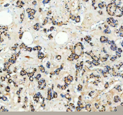 Immunohistochemical staining of SPOPL using anti-SPOPL antibody. SPOPL was detected in a paraffin-embedded section of human thyroid cancer tissue. Heat mediated antigen retrieval was performed in EDTA buffer (pH 8.0, epitope retrieval solution). The tissue section was blocked with 10% goat serum. The tissue section was then incubated with 2 ug/ml rabbit anti-SPOPL antibody overnight at 4oC. Peroxidase Conjugated Goat Anti-rabbit IgG was used as secondary antibody and incubated for 30 minutes at 37oC. The tissue section was developed using an HRP secondary and DAB substrate.