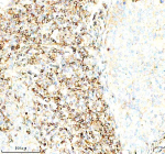 Immunohistochemical staining of SERPING1/C1 using anti-C1 Inhibitor (C1-INH) antibody. SERPING1/C1 was detected in a paraffin-embedded section of human cervical cancer tissue. Heat mediated antigen retrieval was performed in EDTA buffer (pH 8.0, epitope retrieval solution). The tissue section was blocked with 10% goat serum. The tissue section was then incubated with 1:100 rabbit anti-C1 Inhibitor (C1-INH) antibody overnight at 4oC. Peroxidase Conjugated Goat Anti-rabbit IgG was used as secondary antibody and incubated for 30 minutes at 37oC. The tissue section was developed using an HRP secondary and DAB substrate.