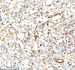 Immunohistochemical staining of SERPING1/C1 using anti-C1 Inhibitor (C1-INH) antibody. SERPING1/C1 was detected in a paraffin-embedded section of human rectal cancer tissue. Heat mediated antigen retrieval was performed in EDTA buffer (pH 8.0, epitope retrieval solution). The tissue section was blocked with 10% goat serum. The tissue section was then incubated with 1:100 rabbit anti-C1 Inhibitor (C1-INH) antibody overnight at 4oC. Peroxidase Conjugated Goat Anti-rabbit IgG was used as secondary antibody and incubated for 30 minutes at 37oC. The tissue section was developed using an HRP secondary and DAB substrate.