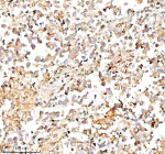 Immunohistochemical staining of SERPING1/C1 using anti-C1 Inhibitor (C1-INH) antibody. SERPING1/C1 was detected in a paraffin-embedded section of human testis cancer tissue. Heat mediated antigen retrieval was performed in EDTA buffer (pH 8.0, epitope retrieval solution). The tissue section was blocked with 10% goat serum. The tissue section was then incubated with 1:100 rabbit anti-C1 Inhibitor (C1-INH) antibody overnight at 4oC. Peroxidase Conjugated Goat Anti-rabbit IgG was used as secondary antibody and incubated for 30 minutes at 37oC. The tissue section was developed using an HRP secondary and DAB substrate.