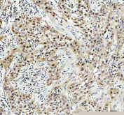 Immunohistochemical staining of POLD1 using anti-POLD1 antibody. POLD1 was detected in a paraffin-embedded section of human bladder cancer tissue. Heat mediated antigen retrieval was performed in EDTA buffer (pH 8.0, epitope retrieval solution). The tissue section was blocked with 10% goat serum. The tissue section was then incubated with 2 ug/ml rabbit anti-POLD1 antibody overnight at 4oC. Peroxidase Conjugated Goat Anti-rabbit IgG was used as secondary antibody and incubated for 30 minutes at 37oC. The tissue section was developed using an HRP secondary and DAB substrate.