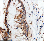Immunohistochemical staining of SHD using anti-SHD antibody. SHD was detected in a paraffin-embedded section of human colon cancer tissue. Heat mediated antigen retrieval was performed in EDTA buffer (pH 8.0, epitope retrieval solution). The tissue section was blocked with 10% goat serum. The tissue section was then incubated with 2 ug/ml rabbit anti-SHD antibody overnight at 4oC. Peroxidase Conjugated Goat Anti-rabbit IgG was used as secondary antibody and incubated for 30 minutes at 37oC. The tissue section was developed using an HRP secondary and DAB substrate.
