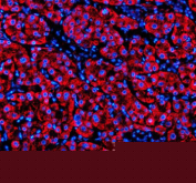 Immunofluorescent staining of SHD using anti-SHD antibody (red). SHD was detected in a paraffin-embedded section of human liver cancer tissue. Heat mediated antigen retrieval was performed in EDTA buffer (pH 8.0, epitope retrieval solution). The tissue section was blocked with 10% goat serum. The tissue section was then incubated with 5 ug/ml rabbit anti-SHD antibody overnight at 4oC. Cy3 Conjugated Goat Anti-Rabbit IgG was used as secondary antibody at 1:500 dilution and incubated for 30 minutes at 37oC. The section was counterstained with DAPI nuclear stain (blue). Visualize using a fluorescence microscope and filter sets appropriate for the label used.