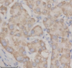 Immunohistochemical staining of SHD using anti-SHD antibody. SHD was detected in a paraffin-embedded section of human liver cancer tissue. Heat mediated antigen retrieval was performed in EDTA buffer (pH 8.0, epitope retrieval solution). The tissue section was blocked with 10% goat serum. The tissue section was then incubated with 2 ug/ml rabbit anti-SHD antibody overnight at 4oC. Peroxidase Conjugated Goat Anti-rabbit IgG was used as secondary antibody and incubated for 30 minutes at 37oC. The tissue section was developed using an HRP secondary and DAB substrate.