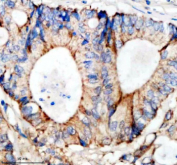 Immunohistochemical staining of SHD using anti-SHD antibody. SHD was detected in a paraffin-embedded section of human colon cancer tissue. Heat mediated antigen retrieval was performed in EDTA buffer (pH 8.0, epitope retrieval solution). The tissue section was blocked with 10% goat serum. The tissue section was then incubated with 2 ug/ml rabbit anti-SHD antibody overnight at 4oC. Peroxidase Conjugated Goat Anti-rabbit IgG was used as secondary antibody and incubated for 30 minutes at 37oC. The tissue section was developed using an HRP secondary and DAB substrate.