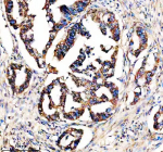 Immunohistochemical staining of STX4 using anti-STX4 antibody. STX4 was detected in a paraffin-embedded section of human colon cancer tissue. Heat mediated antigen retrieval was performed in EDTA buffer (pH 8.0, epitope retrieval solution). The tissue section was blocked with 10% goat serum. The tissue section was then incubated with 2 ug/ml rabbit anti-STX4 antibody overnight at 4oC. Peroxidase Conjugated Goat Anti-rabbit IgG was used as secondary antibody and incubated for 30 minutes at 37oC. The tissue section was developed using an HRP secondary and DAB substrate.