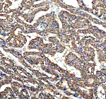 Immunohistochemical staining of QRSL1 using anti-QRSL1 antibody. QRSL1 was detected in a paraffin-embedded section of human thyroid cancer tissue. Heat mediated antigen retrieval was performed in EDTA buffer (pH 8.0, epitope retrieval solution). The tissue section was blocked with 10% goat serum. The tissue section was then incubated with 2 ug/ml rabbit anti-QRSL1 antibody overnight at 4oC. Peroxidase Conjugated Goat Anti-rabbit IgG was used as secondary antibody and incubated for 30 minutes at 37oC. The tissue section was developed using an HRP secondary and DAB substrate.