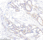 Immunohistochemical staining of PLS1 using anti-PLS1 antibody. PLS1 was detected in a paraffin-embedded section of human colon cancer tissue. Heat mediated antigen retrieval was performed in EDTA buffer (pH 8.0, epitope retrieval solution). The tissue section was blocked with 10% goat serum. The tissue section was then incubated with 2 ug/ml rabbit anti-PLS1 antibody overnight at 4oC. Peroxidase Conjugated Goat Anti-rabbit IgG was used as secondary antibody and incubated for 30 minutes at 37oC. The tissue section was developed using an HRP secondary and DAB substrate.
