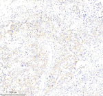 Immunohistochemical staining of PLS1 using anti-PLS1 antibody. PLS1 was detected in a paraffin-embedded section of human stomach cancer tissue. Heat mediated antigen retrieval was performed in EDTA buffer (pH 8.0, epitope retrieval solution). The tissue section was blocked with 10% goat serum. The tissue section was then incubated with 2 ug/ml rabbit anti-PLS1 antibody overnight at 4oC. Peroxidase Conjugated Goat Anti-rabbit IgG was used as secondary antibody and incubated for 30 minutes at 37oC. The tissue section was developed using an HRP secondary and DAB substrate.