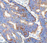 Immunohistochemical staining of IER3 using anti-IER3 antibody. IER3 was detected in a paraffin-embedded section of human stomach cancer tissue. Heat mediated antigen retrieval was performed in EDTA buffer (pH 8.0, epitope retrieval solution). The tissue section was blocked with 10% goat serum. The tissue section was then incubated with 2 ug/ml rabbit anti-IER3 antibody overnight at 4oC. Peroxidase Conjugated Goat Anti-rabbit IgG was used as secondary antibody and incubated for 30 minutes at 37oC. The tissue section was developed using an HRP secondary and DAB substrate.