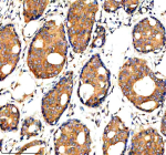 Immunohistochemical staining of ADAMTS1 using anti-ADAMTS1 antibody. ADAMTS1 was detected in a paraffin-embedded section of human breast cancer tissue. Heat mediated antigen retrieval was performed in EDTA buffer (pH 8.0, epitope retrieval solution). The tissue section was blocked with 10% goat serum. The tissue section was then incubated with 2 ug/ml rabbit anti-ADAMTS1 antibody overnight at 4oC. Peroxidase Conjugated Goat Anti-rabbit IgG was used as secondary antibody and incubated for 30 minutes at 37oC. The tissue section was developed using an HRP secondary and DAB substrate.