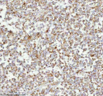 Immunohistochemical staining of MELTF using anti-MELTF antibody. MELTF was detected in a paraffin-embedded section of human melanoma cancer tissue. Heat mediated antigen retrieval was performed in EDTA buffer (pH 8.0, epitope retrieval solution). The tissue section was blocked with 10% goat serum. The tissue section was then incubated with 2 ug/ml rabbit anti-MELTF antibody overnight at 4oC. Peroxidase Conjugated Goat Anti-rabbit IgG was used as secondary antibody and incubated for 30 minutes at 37oC. The tissue section was developed using an HRP secondary and DAB substrate.