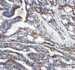 Immunohistochemical staining of Tubulin Alpha using anti-Alpha Tubulin antibody. Tubulin Alpha was detected in a paraffin-embedded section of human thyroid cancer tissue. Heat mediated antigen retrieval was performed in EDTA buffer (pH 8.0, epitope retrieval solution). The tissue section was blocked with 10% goat serum. The tissue section was then incubated with 2 ug/ml rabbit anti-Alpha Tubulin antibody overnight at 4oC. Peroxidase Conjugated Goat Anti-rabbit IgG was used as secondary antibody and incubated for 30 minutes at 37oC. The tissue section was developed using an HRP secondary and DAB substrate.