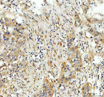 Immunohistochemical staining of Tubulin Alpha using anti-Alpha Tubulin antibody. Tubulin Alpha was detected in a paraffin-embedded section of human urothelial carcinoma with squamous differentiation tissue. Heat mediated antigen retrieval was performed in EDTA buffer (pH 8.0, epitope retrieval solution). The tissue section was blocked with 10% goat serum. The tissue section was then incubated with 2 ug/ml rabbit anti-Alpha Tubulin antibody overnight at 4oC. Peroxidase Conjugated Goat Anti-rabbit IgG was used as secondary antibody and incubated for 30 minutes at 37oC. The tissue section was developed using an HRP secondary and DAB substrate.