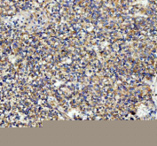 Immunohistochemical staining of Tubulin Alpha using anti-Alpha Tubulin antibody. Tubulin Alpha was detected in a paraffin-embedded section of human lung cancer tissue. Heat mediated antigen retrieval was performed in EDTA buffer (pH 8.0, epitope retrieval solution). The tissue section was blocked with 10% goat serum. The tissue section was then incubated with 2 ug/ml rabbit anti-Alpha Tubulin antibody overnight at 4oC. Peroxidase Conjugated Goat Anti-rabbit IgG was used as secondary antibody and incubated for 30 minutes at 37oC. The tissue section was developed using an HRP secondary and DAB substrate.