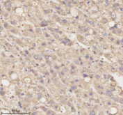 Immunohistochemical staining of MEST using anti-MEST antibody. MEST was detected in a paraffin-embedded section of human liver cancer tissue. Heat mediated antigen retrieval was performed in EDTA buffer (pH 8.0, epitope retrieval solution). The tissue section was blocked with 10% goat serum. The tissue section was then incubated with 2 ug/ml rabbit anti-MEST antibody overnight at 4oC. Peroxidase Conjugated Goat Anti-rabbit IgG was used as secondary antibody and incubated for 30 minutes at 37oC. The tissue section was developed using an HRP secondary and DAB substrate.