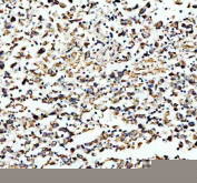 Immunohistochemical staining of HADHA using anti-HADHA antibody. HADHA was detected in a paraffin-embedded section of human testis cancer tissue. Heat mediated antigen retrieval was performed in EDTA buffer (pH 8.0, epitope retrieval solution). The tissue section was blocked with 10% goat serum. The tissue section was then incubated with 2 ug/ml rabbit anti-HADHA antibody overnight at 4oC. Peroxidase Conjugated Goat Anti-rabbit IgG was used as secondary antibody and incubated for 30 minutes at 37oC. The tissue section was developed using an HRP secondary and DAB substrate.