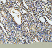 Immunohistochemical staining of HADHA using anti-HADHA antibody. HADHA was detected in a paraffin-embedded section of human thyroid papillary carcinoma tissue. Heat mediated antigen retrieval was performed in EDTA buffer (pH 8.0, epitope retrieval solution). The tissue section was blocked with 10% goat serum. The tissue section was then incubated with 2 ug/ml rabbit anti-HADHA antibody overnight at 4oC. Peroxidase Conjugated Goat Anti-rabbit IgG was used as secondary antibody and incubated for 30 minutes at 37oC. The tissue section was developed using an HRP secondary and DAB substrate.