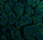 Immunofluorescent staining of FFPE human lung cancer tissue with HDAHA antibody (green) and DAPI nuclear stain (blue). HIER: steam section in pH8 EDTA buffer for 20 min.