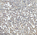Immunohistochemical staining of HADHA using anti-HADHA antibody. HADHA was detected in a paraffin-embedded section of human colon adenocarcinoma tissue. Heat mediated antigen retrieval was performed in EDTA buffer (pH 8.0, epitope retrieval solution). The tissue section was blocked with 10% goat serum. The tissue section was then incubated with 2 ug/ml rabbit anti-HADHA antibody overnight at 4oC. Peroxidase Conjugated Goat Anti-rabbit IgG was used as secondary antibody and incubated for 30 minutes at 37oC. The tissue section was developed using an HRP secondary and DAB substrate.