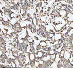 Immunohistochemical staining of HADHA using anti-HADHA antibody. HADHA was detected in a paraffin-embedded section of human colon adenocarcinoma tissue. Heat mediated antigen retrieval was performed in EDTA buffer (pH 8.0, epitope retrieval solution). The tissue section was blocked with 10% goat serum. The tissue section was then incubated with 2 ug/ml rabbit anti-HADHA antibody overnight at 4oC. Peroxidase Conjugated Goat Anti-rabbit IgG was used as secondary antibody and incubated for 30 minutes at 37oC. The tissue section was developed using an HRP secondary and DAB substrate.