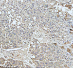 Immunohistochemical staining of HADHA using anti-HADHA antibody. HADHA was detected in a paraffin-embedded section of human liver cancer tissue. Heat mediated antigen retrieval was performed in EDTA buffer (pH 8.0, epitope retrieval solution). The tissue section was blocked with 10% goat serum. The tissue section was then incubated with 2 ug/ml rabbit anti-HADHA antibody overnight at 4oC. Peroxidase Conjugated Goat Anti-rabbit IgG was used as secondary antibody and incubated for 30 minutes at 37oC. The tissue section was developed using an HRP secondary and DAB substrate.