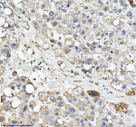 Immunohistochemical staining of HADHA using anti-HADHA antibody. HADHA was detected in a paraffin-embedded section of human liver cancer tissue. Heat mediated antigen retrieval was performed in EDTA buffer (pH 8.0, epitope retrieval solution). The tissue section was blocked with 10% goat serum. The tissue section was then incubated with 2 ug/ml rabbit anti-HADHA antibody overnight at 4oC. Peroxidase Conjugated Goat Anti-rabbit IgG was used as secondary antibody and incubated for 30 minutes at 37oC. The tissue section was developed using an HRP secondary and DAB substrate.