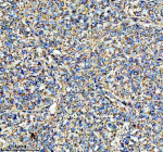 Immunohistochemical staining of HADHA using anti-HADHA antibody. HADHA was detected in a paraffin-embedded section of human non-small cell lung cancer tissue. Heat mediated antigen retrieval was performed in EDTA buffer (pH 8.0, epitope retrieval solution). The tissue section was blocked with 10% goat serum. The tissue section was then incubated with 2 ug/ml rabbit anti-HADHA antibody overnight at 4oC. Peroxidase Conjugated Goat Anti-rabbit IgG was used as secondary antibody and incubated for 30 minutes at 37oC. The tissue section was developed using an HRP secondary and DAB substrate.