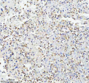 Immunohistochemical staining of GLIPR2 using anti-GLIPR2 antibody. GLIPR2 was detected in a paraffin-embedded section of human lung cancer tissue. Heat mediated antigen retrieval was performed in EDTA buffer (pH 8.0, epitope retrieval solution). The tissue section was blocked with 10% goat serum. The tissue section was then incubated with 2 ug/ml rabbit anti-GLIPR2 antibody overnight at 4oC. Peroxidase Conjugated Goat Anti-rabbit IgG was used as secondary antibody and incubated for 30 minutes at 37oC. The tissue section was developed using an HRP secondary and DAB substrate.