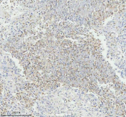 Immunohistochemical staining of GLIPR2 using anti-GLIPR2 antibody. GLIPR2 was detected in a paraffin-embedded section of human lung cancer tissue. Heat mediated antigen retrieval was performed in EDTA buffer (pH 8.0, epitope retrieval solution). The tissue section was blocked with 10% goat serum. The tissue section was then incubated with 2 ug/ml rabbit anti-GLIPR2 antibody overnight at 4oC. Peroxidase Conjugated Goat Anti-rabbit IgG was used as secondary antibody and incubated for 30 minutes at 37oC. The tissue section was developed using an HRP secondary and DAB substrate.