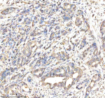 Immunohistochemical staining of GATM using anti-GATM antibody. GATM was detected in a paraffin-embedded section of human pancreas cancer tissue. Heat mediated antigen retrieval was performed in EDTA buffer (pH 8.0, epitope retrieval solution). The tissue section was blocked with 10% goat serum. The tissue section was then incubated with 2 ug/ml rabbit anti-GATM antibody overnight at 4oC. Peroxidase Conjugated Goat Anti-rabbit IgG was used as secondary antibody and incubated for 30 minutes at 37oC. The tissue section was developed using an HRP secondary and DAB substrate.