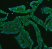 Immunofluorescent staining of GATM using anti-GATM antibody (green). GATM was detected in a paraffin-embedded section of human breast cancer tissue. Heat mediated antigen retrieval was performed in EDTA buffer (pH 8.0, epitope retrieval solution). The tissue section was blocked with 10% goat serum. The tissue section was then incubated with 5 ug/ml rabbit anti-GATM antibody overnight at 4oC. DyLight 488 Conjugated Goat Anti-Rabbit IgG was used as secondary antibody at 1:500 dilution and incubated for 30 minutes at 37oC. The section was counterstained with DAPI nuclear stain (blue). Visualize using a fluorescence microscope and filter sets appropriate for the label used.