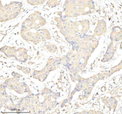 Immunohistochemical staining of GATM using anti-GATM antibody. GATM was detected in a paraffin-embedded section of human breast cancer tissue. Heat mediated antigen retrieval was performed in EDTA buffer (pH 8.0, epitope retrieval solution). The tissue section was blocked with 10% goat serum. The tissue section was then incubated with 2 ug/ml rabbit anti-GATM antibody overnight at 4oC. Peroxidase Conjugated Goat Anti-rabbit IgG was used as secondary antibody and incubated for 30 minutes at 37oC. The tissue section was developed using an HRP secondary and DAB substrate.