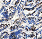 Immunohistochemical staining of Ki67/MKI67 using anti-Ki-67 antibody. Ki67/MKI67 was detected in a paraffin-embedded section of human colon cancer tissue. Heat mediated antigen retrieval was performed in EDTA buffer (pH 8.0, epitope retrieval solution). The tissue section was blocked with 10% goat serum. The tissue section was then incubated with 1:50 rabbit anti-Ki-67 antibody overnight at 4oC. Peroxidase Conjugated Goat Anti-rabbit IgG was used as secondary antibody and incubated for 30 minutes at 37oC. The tissue section was developed using an HRP secondary and DAB substrate.