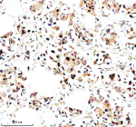 Immunohistochemical staining of NR1D1 using anti-NR1D1 antibody. NR1D1 was detected in a paraffin-embedded section of human breast cancer tissue. Heat mediated antigen retrieval was performed in EDTA buffer (pH 8.0, epitope retrieval solution). The tissue section was blocked with 10% goat serum. The tissue section was then incubated with 2 ug/ml rabbit anti-NR1D1 antibody overnight at 4oC. Peroxidase Conjugated Goat Anti-rabbit IgG was used as secondary antibody and incubated for 30 minutes at 37oC. The tissue section was developed using an HRP secondary and DAB substrate.