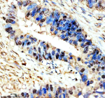 Immunohistochemical staining of NR1D1 using anti-NR1D1 antibody. NR1D1 was detected in a paraffin-embedded section of human colon cancer tissue. Heat mediated antigen retrieval was performed in EDTA buffer (pH 8.0, epitope retrieval solution). The tissue section was blocked with 10% goat serum. The tissue section was then incubated with 2 ug/ml rabbit anti-NR1D1 antibody overnight at 4oC. Peroxidase Conjugated Goat Anti-rabbit IgG was used as secondary antibody and incubated for 30 minutes at 37oC. The tissue section was developed using an HRP secondary and DAB substrate.