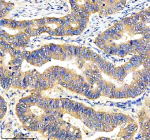 Immunohistochemical staining of DEPDC6/DEPTOR using anti-DEPTOR antibody. DEPDC6/DEPTOR was detected in a paraffin-embedded section of human stomach cancer tissue. Heat mediated antigen retrieval was performed in EDTA buffer (pH 8.0, epitope retrieval solution). The tissue section was blocked with 10% goat serum. The tissue section was then incubated with 2 ug/ml rabbit anti-DEPTOR antibody overnight at 4oC. Peroxidase Conjugated Goat Anti-rabbit IgG was used as secondary antibody and incubated for 30 minutes at 37oC. The tissue section was developed using an HRP secondary and DAB substrate.