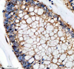 Immunohistochemical staining of SFXN4 using anti-SFXN4 antibody. SFXN4 was detected in a paraffin-embedded section of human colon cancer tissue. Heat mediated antigen retrieval was performed in EDTA buffer (pH 8.0, epitope retrieval solution). The tissue section was blocked with 10% goat serum. The tissue section was then incubated with 2 ug/ml rabbit anti-SFXN4 antibody overnight at 4oC. Peroxidase Conjugated Goat Anti-rabbit IgG was used as secondary antibody and incubated for 30 minutes at 37oC. The tissue section was developed using an HRP secondary and DAB substrate.