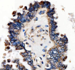 Immunohistochemical staining of SFXN4 using anti-SFXN4 antibody. SFXN4 was detected in a paraffin-embedded section of human ovarian cancer tissue. Heat mediated antigen retrieval was performed in EDTA buffer (pH 8.0, epitope retrieval solution). The tissue section was blocked with 10% goat serum. The tissue section was then incubated with 2 ug/ml rabbit anti-SFXN4 antibody overnight at 4oC. Peroxidase Conjugated Goat Anti-rabbit IgG was used as secondary antibody and incubated for 30 minutes at 37oC. The tissue section was developed using an HRP secondary and DAB substrate.