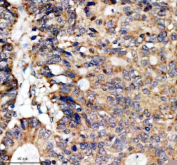 Immunohistochemical staining of SFXN4 using anti-SFXN4 antibody. SFXN4 was detected in a paraffin-embedded section of human colon cancer tissue. Heat mediated antigen retrieval was performed in EDTA buffer (pH 8.0, epitope retrieval solution). The tissue section was blocked with 10% goat serum. The tissue section was then incubated with 2 ug/ml rabbit anti-SFXN4 antibody overnight at 4oC. Peroxidase Conjugated Goat Anti-rabbit IgG was used as secondary antibody and incubated for 30 minutes at 37oC. The tissue section was developed using an HRP secondary and DAB substrate.