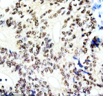 Immunohistochemical staining of SON using anti-SON antibody. SON was detected in a paraffin-embedded section of human colon cancer tissue. Heat mediated antigen retrieval was performed in EDTA buffer (pH 8.0, epitope retrieval solution). The tissue section was blocked with 10% goat serum. The tissue section was then incubated with 2 ug/ml rabbit anti-SON antibody overnight at 4oC. Peroxidase Conjugated Goat Anti-rabbit IgG was used as secondary antibody and incubated for 30 minutes at 37oC. The tissue section was developed using an HRP secondary and DAB substrate.