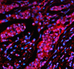 Immunofluorescent staining of SON using anti-SON antibody (red). SON was detected in a paraffin-embedded section of human liver cancer tissue. Heat mediated antigen retrieval was performed in EDTA buffer (pH 8.0, epitope retrieval solution). The tissue section was blocked with 10% goat serum. The tissue section was then incubated with 5 ug/ml rabbit anti-SON antibody overnight at 4oC. Cy3 Conjugated Goat Anti-Rabbit IgG was used as secondary antibody at 1:500 dilution and incubated for 30 minutes at 37oC. The section was counterstained with DAPI nuclear stain (blue). Visualize using a fluorescence microscope and filter sets appropriate for the label used.