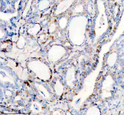 Immunohistochemical staining using SLC25A12 antibody on paraffin-embedded human thyroid cancer tissue sections. Heat-induced epitope retrieval was performed using EDTA buffer (pH 8.0) prior to antibody incubation. Sections were blocked with 10% goat serum and incubated with SLC25A12 antibody overnight at 4C. Detection was carried out using an HRP-based secondary antibody with DAB as the chromogen. Staining demonstrates cytoplasmic immunoreactivity in tumor cells. Nuclei were counterstained with hematoxylin.