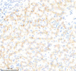 Immunohistochemical staining of BDKRB2 using anti-BDKRB2 antibody. BDKRB2 was detected in a paraffin-embedded section of human liver cancer tissue. Heat mediated antigen retrieval was performed in EDTA buffer (pH 8.0, epitope retrieval solution). The tissue section was blocked with 10% goat serum. The tissue section was then incubated with 1:200 rabbit anti-BDKRB2 antibody overnight at 4oC. Peroxidase Conjugated Goat Anti-rabbit IgG was used as secondary antibody and incubated for 30 minutes at 37oC. The tissue section was developed using an HRP secondary and DAB substrate.